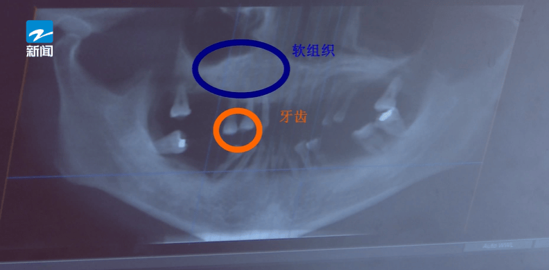 皇冠信用盘登123出租_44岁女子牙齿掉光皇冠信用盘登123出租！只因这个很多人都忽视的“小问题”……